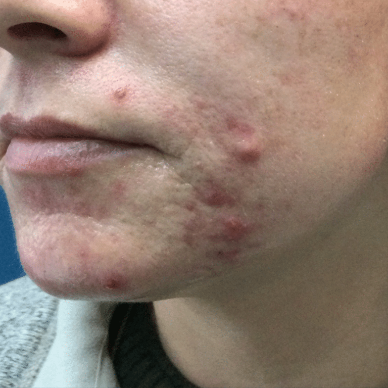 Before Image: Custom Acne Plan - left-front-oblique