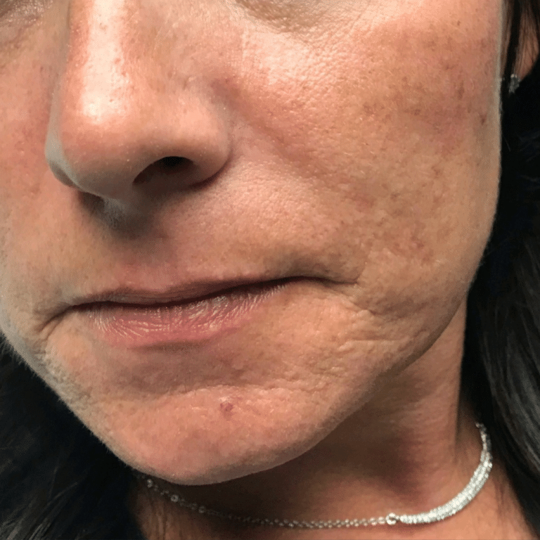 After Image: Custom Acne Plan - left-front-oblique