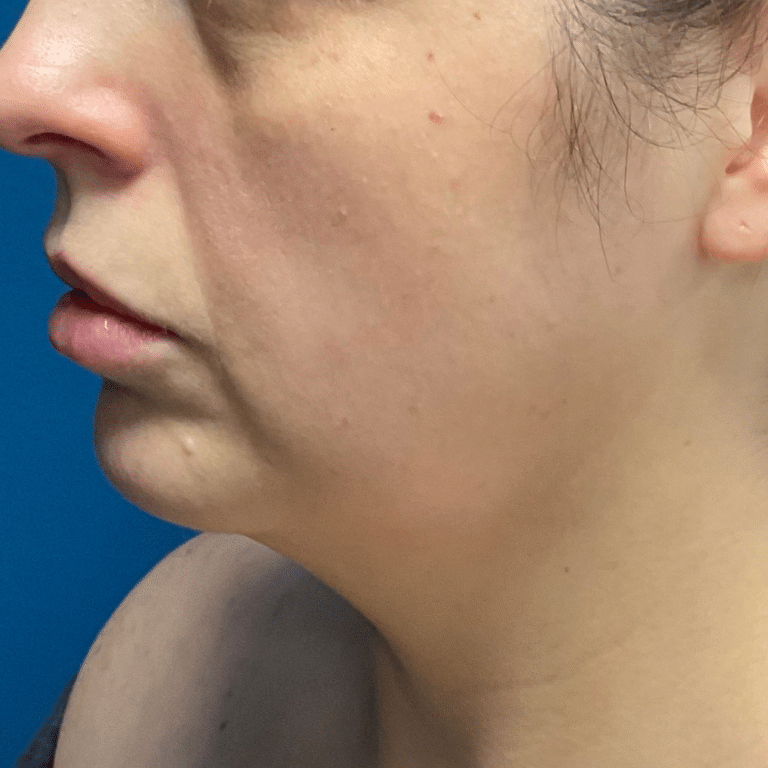 Before Image: Chin Liposuction, Skin Tightening, & Facial Fillers - left-side