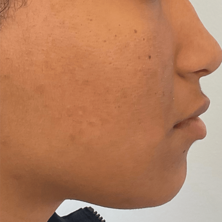 After Image: Custom Acne Plan - right-side