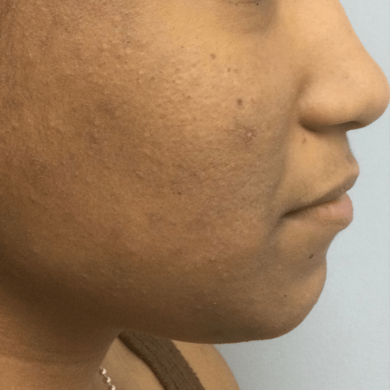 Before Image: Custom Acne Plan - right-side