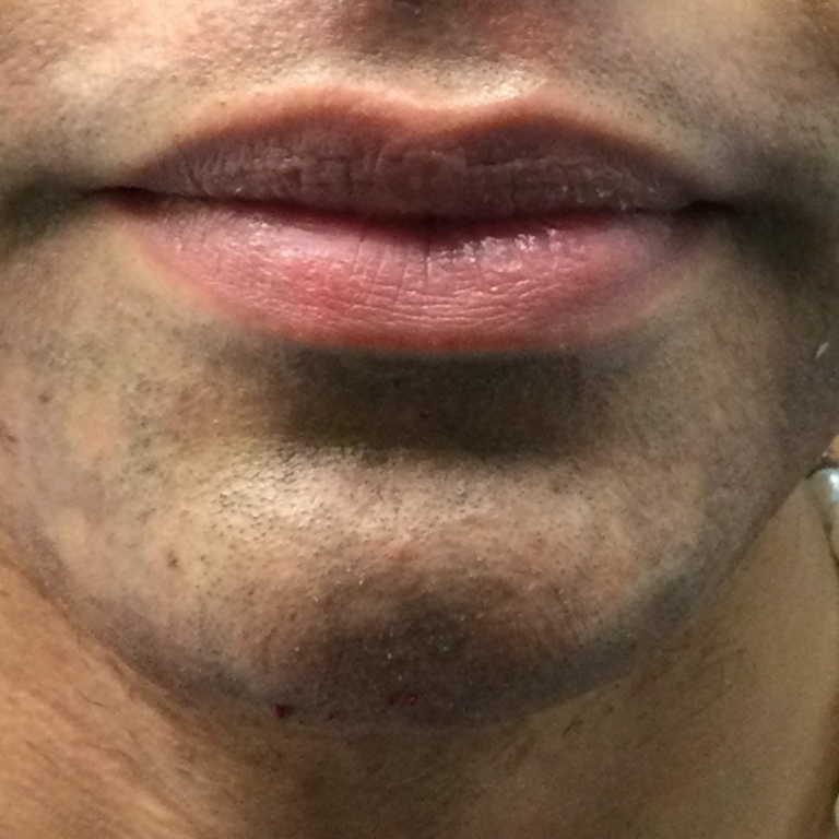 After Image: Chin Filler - front