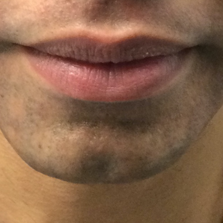 Before Image: Chin Filler - front