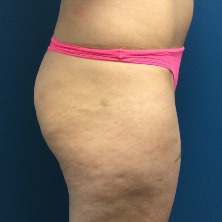 Before Image: Nonsurgical BBL - right-side