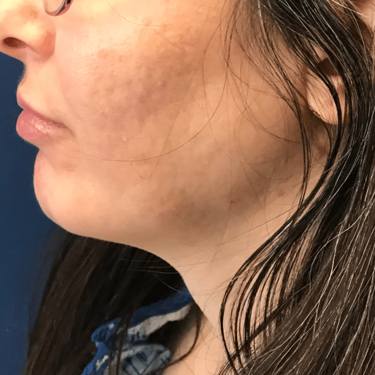 After Image: Facial Filler - left-side