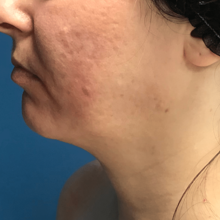 Before Image: Facial Filler - left-side