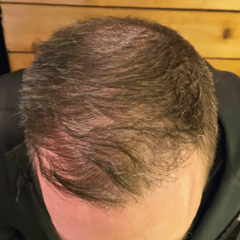 After Image: Hair Restoration - front