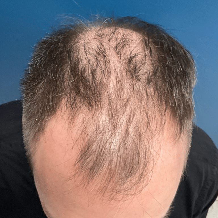 Before Image: Hair Restoration - front