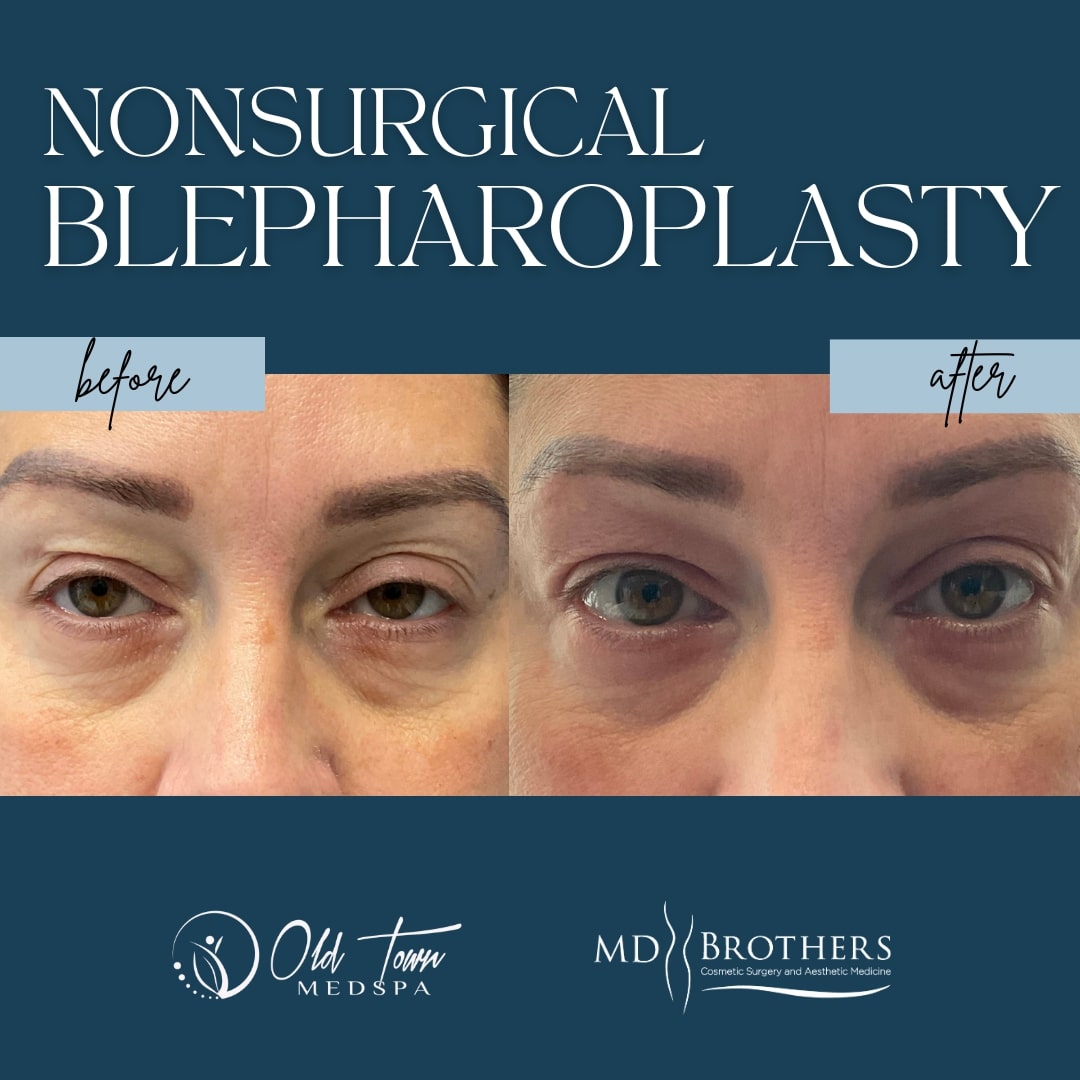 Before & After Non-surgical Blepharoplasty Chicago IL