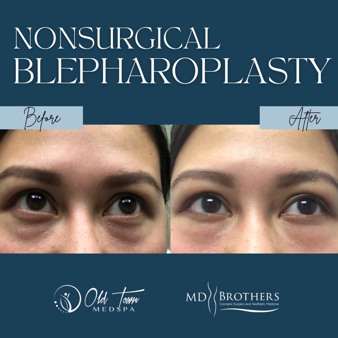 Before & After Non-surgical Blepharoplasty Lincoln Park IL