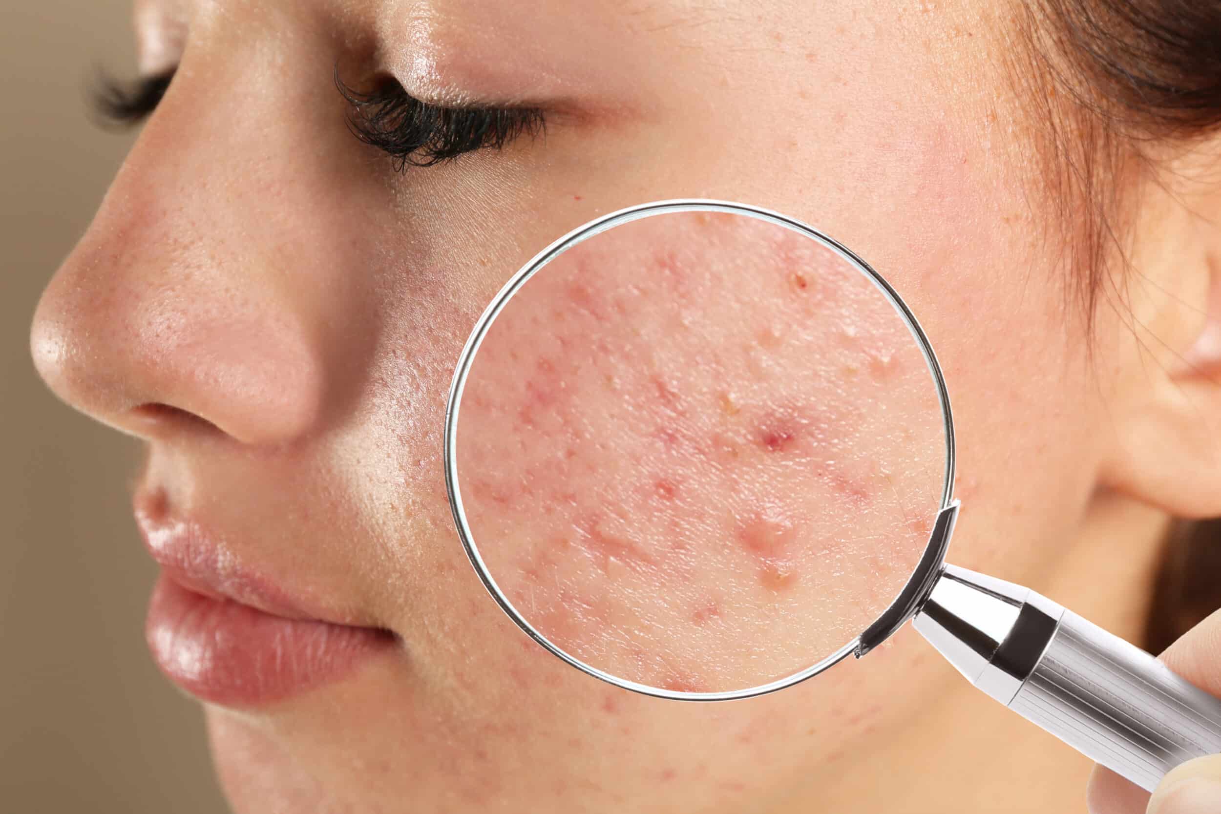 Acne Treatment Lincoln Park IL