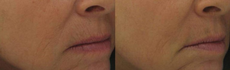Before & After Laser Peel Lincoln Park IL