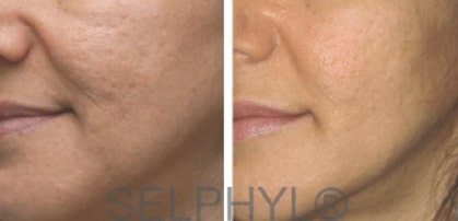 Before and After Stretch Mark and Scar Reduction in Chicago IL