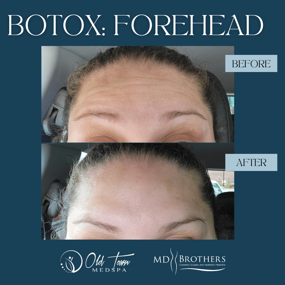 Before and After Botox Treatments Chicago IL