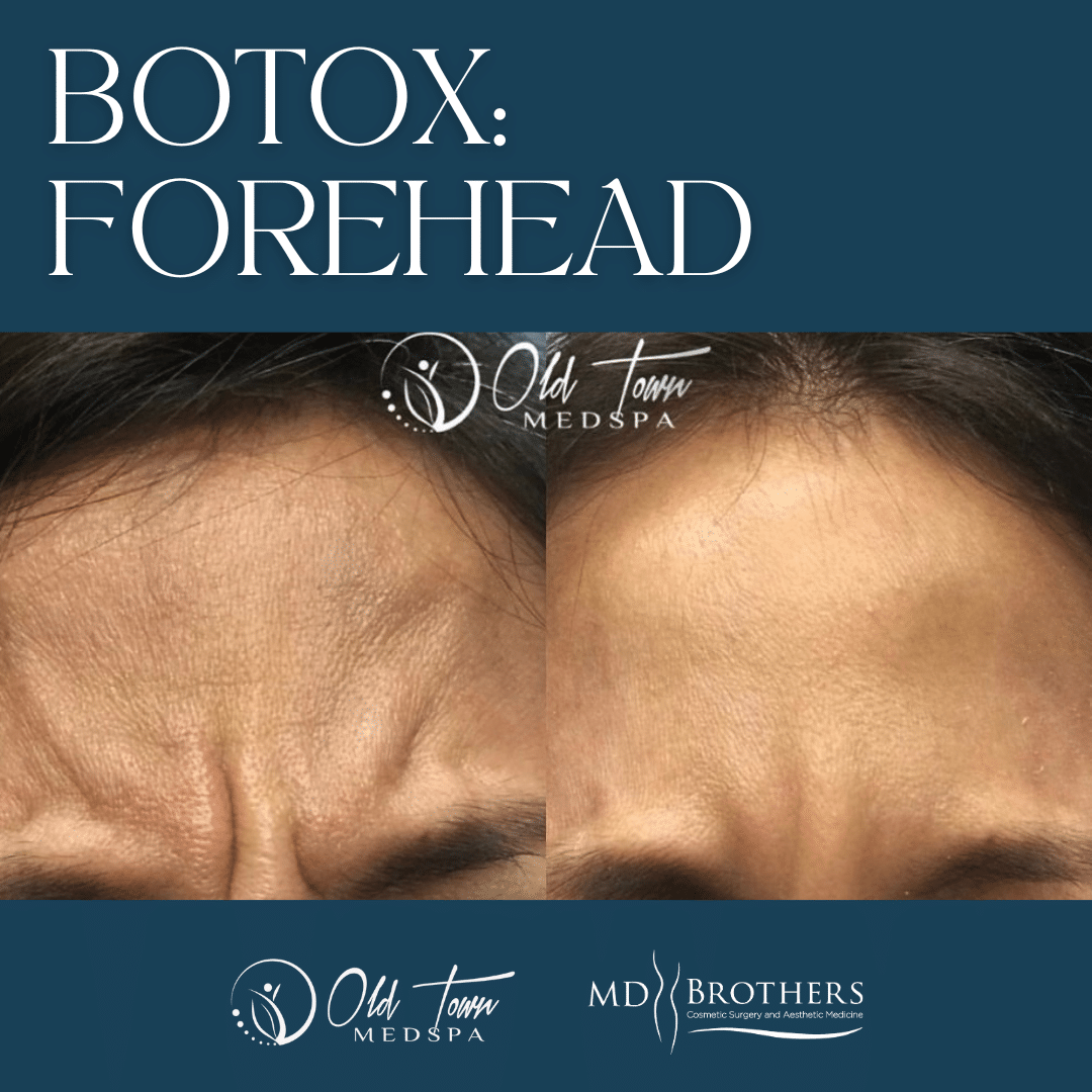 Botox Forehead Chicago IL