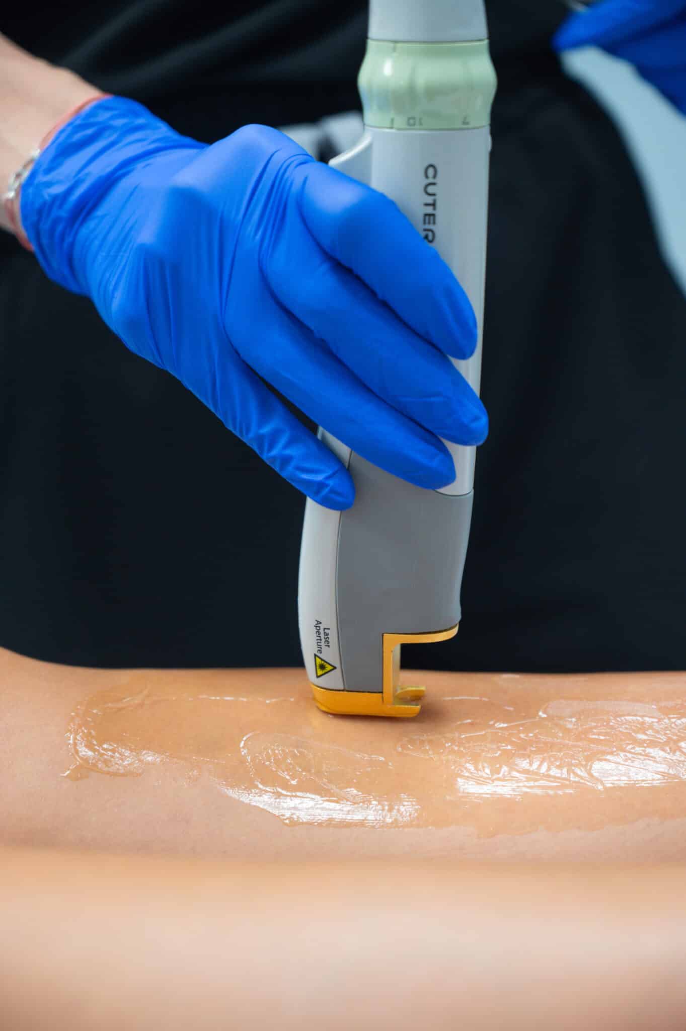 Laser hair removal at Old Town Med Spa using advanced laser technology.