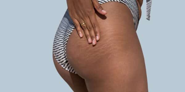 Stretch Mark and Scar Reduction in Chicago IL